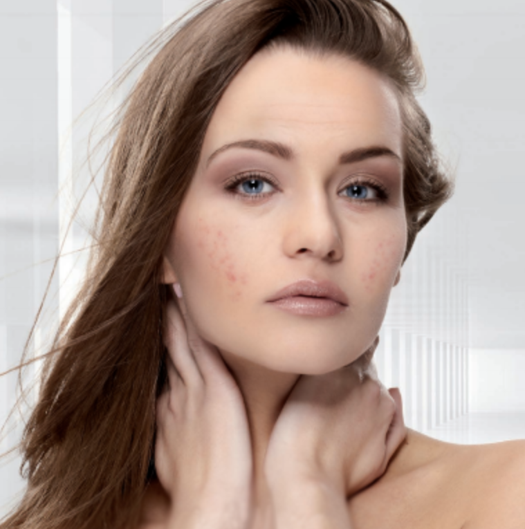 Institut_Rembel_traitement_de_l_acne