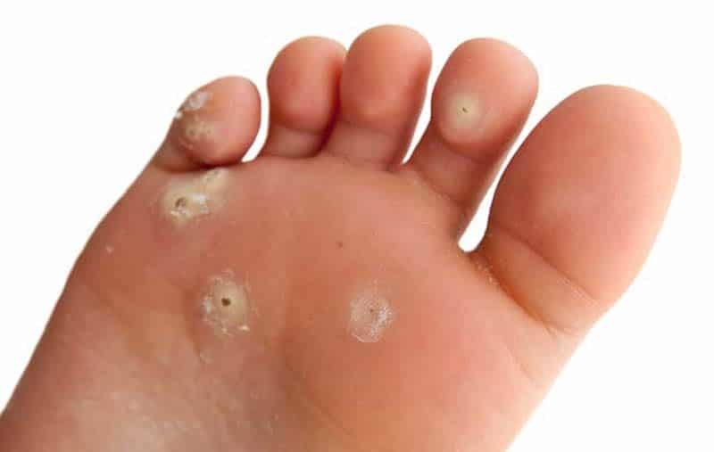 Beauté des pieds et traitements des cors